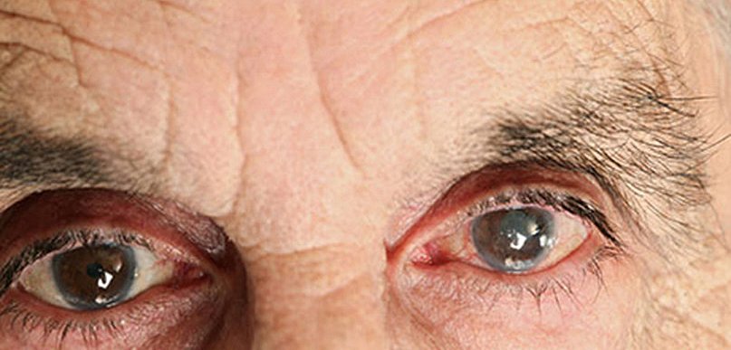 Zaćma - najgroźniejsza po 60. roku życia