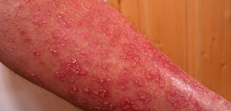 Łuszczyca - konsekwencje choroby autoimmunologicznej